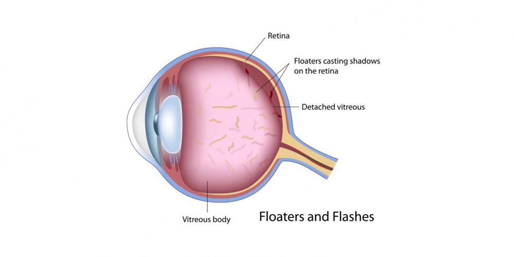 Eye Floaters And Flashes Victoria Health